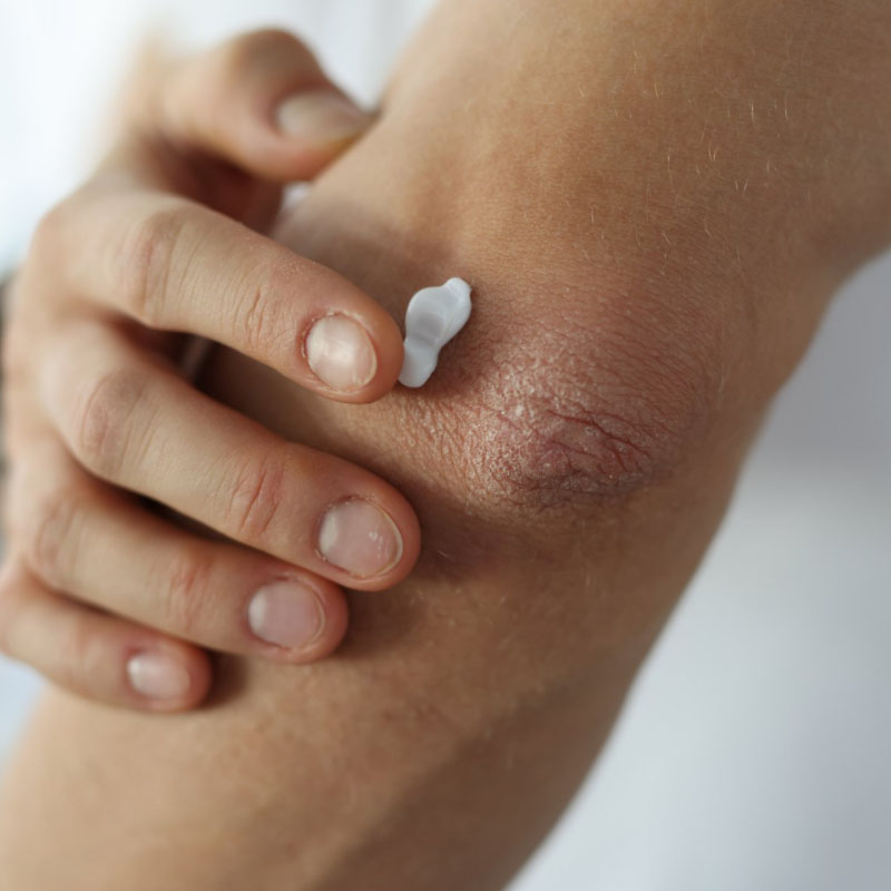 psoriasis